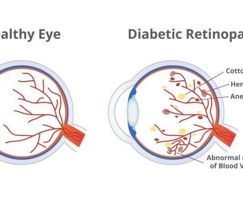 Vector illustration of diabetic retinopathy, a complication of diabetes caused by high blood sugar and normal healthy eye isolated. Cotton wool spots, hemorrhages, aneurysms, abnormal blood vessels.