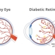 Vector illustration of diabetic retinopathy, a complication of diabetes caused by high blood sugar and normal healthy eye isolated. Cotton wool spots, hemorrhages, aneurysms, abnormal blood vessels.