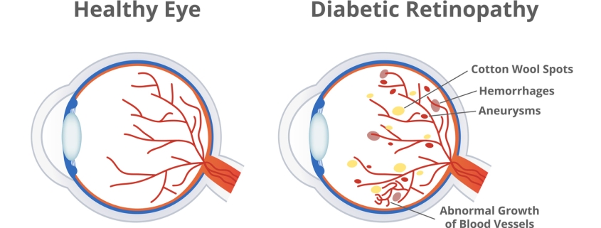 Vector illustration of diabetic retinopathy, a complication of diabetes caused by high blood sugar and normal healthy eye isolated. Cotton wool spots, hemorrhages, aneurysms, abnormal blood vessels.